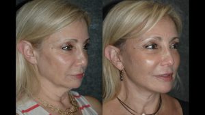 Neck and jaw lift without surgery
